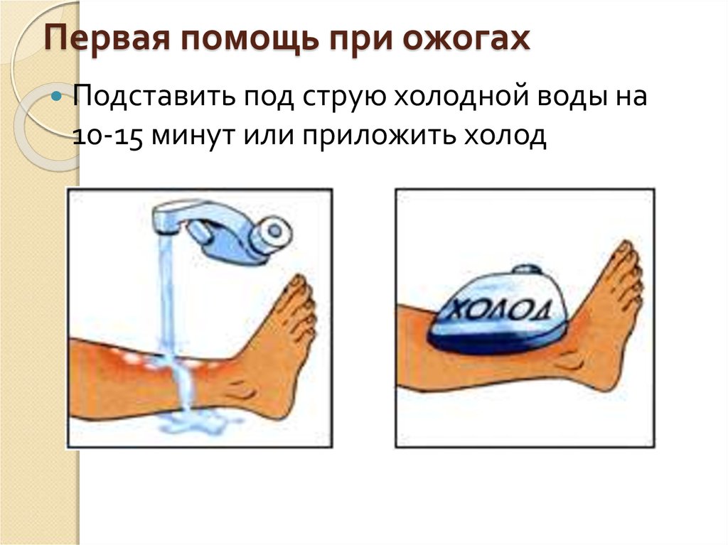 Первая помощь при термических ожогах картинки