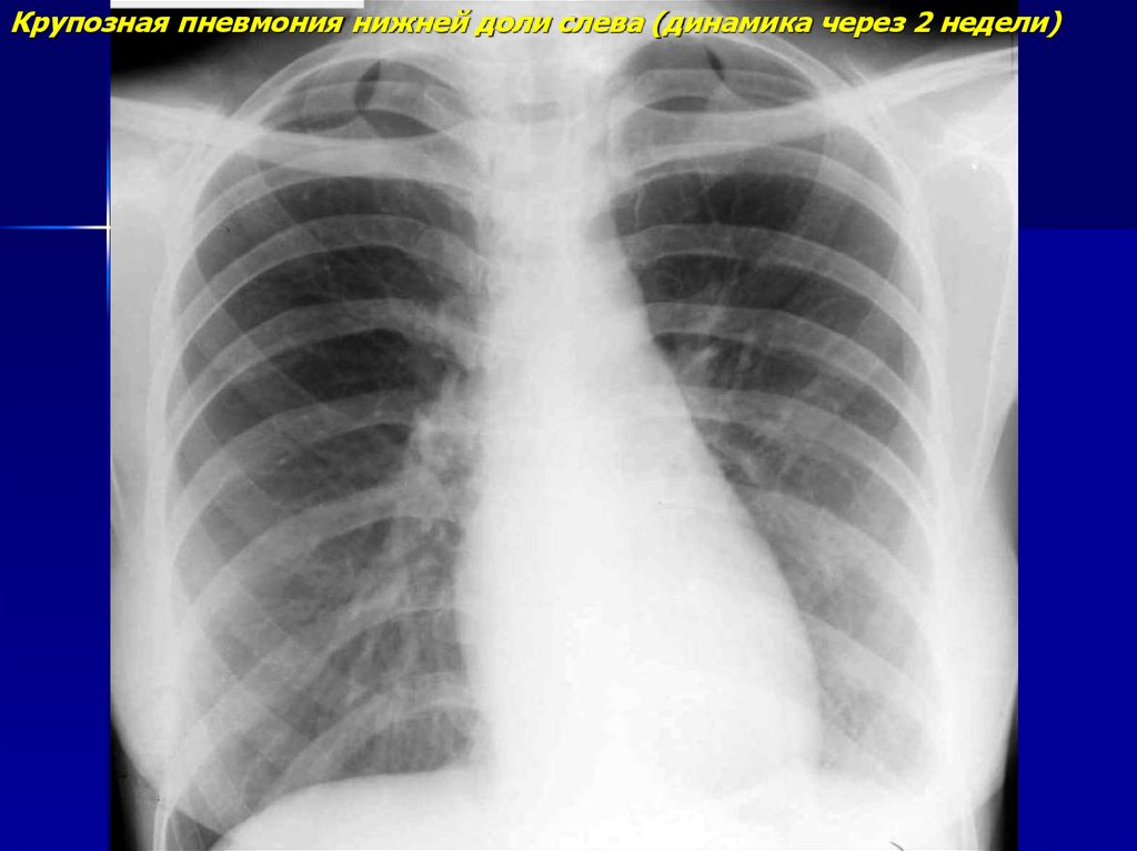 Крупозная пневмония. Крупозная пневмония нижней доли правого легкого. Крупозная пневмония легкого исход.