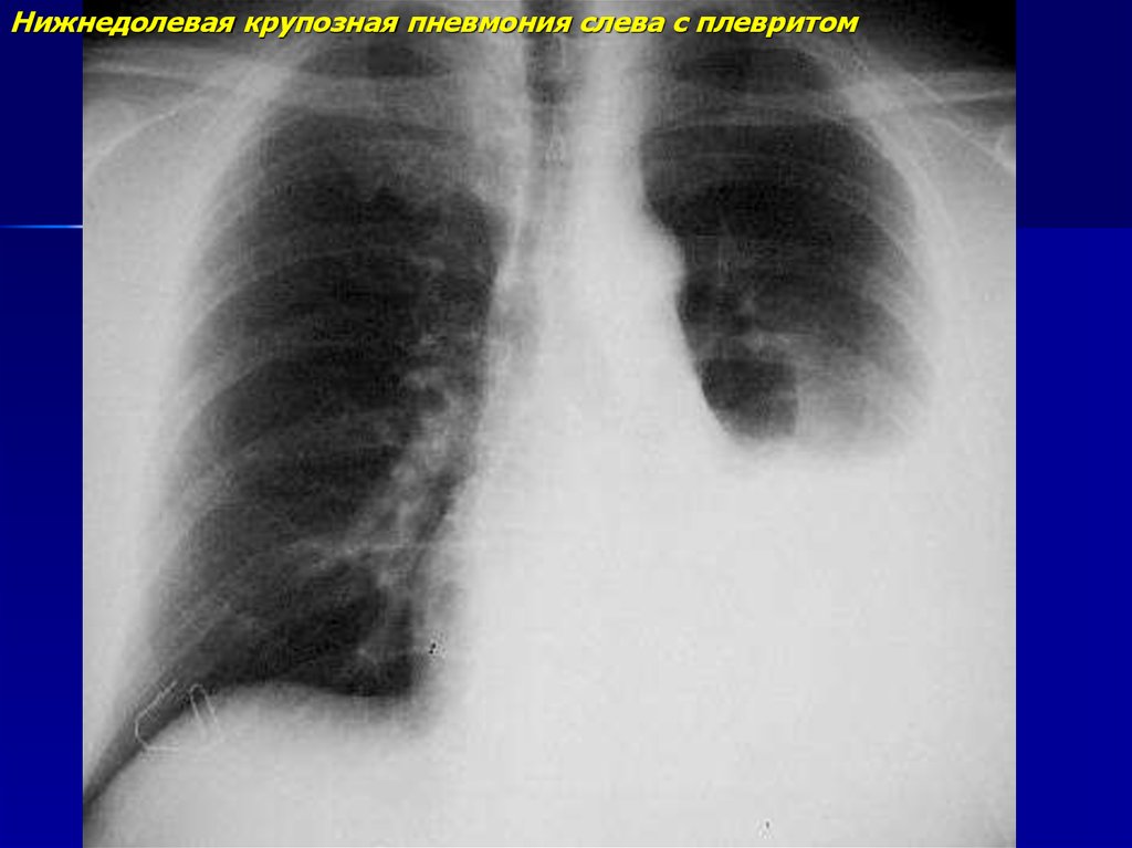 Нижнедолевая пневмония. Пневмонический плеврит. Нижнедолевая крупозная пневмония. Левосторонний экссудативный плеврит.