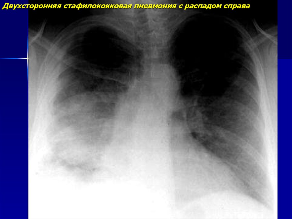 Двухсторонняя пневмония. Стафилококковая пневмония рентген. Стафилококковая пневмония рентген картина. Стафилококковая деструкция легких рентген. Стафилококковая абсцедирующая пневмония.