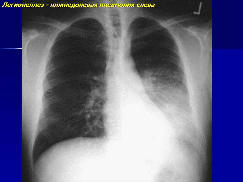 Пневмония в правом легком в нижней доле. Левосторонняя нижнедолевая пневмония рентген. Правосторонняя нижнедолевая пневмония рентген. Левосторонняя нижнедолевая очаговая пневмония. Нижнедолевая очаговая пневмония рентген.