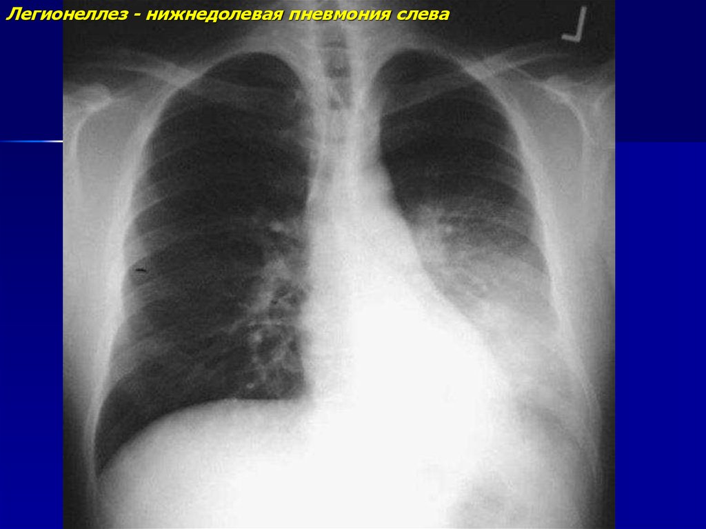 Правосторонняя нижнедолевая пневмония. Левосторонняя нижнедолевая пневмония рентген. Левосторонняя пневмония рентген. Правосторонняя нижнедолевая пневмония рентген. Левосторонняя нижнедолевая очаговая пневмония.