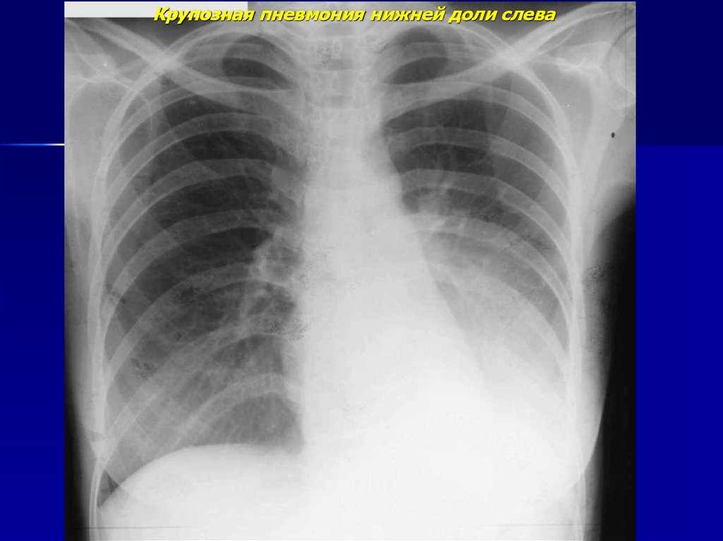Пневмония в правом легком в нижней доле. Крупозная пневмония рентгенограмма. Левосторонняя пневмония рентген. Левосторонняя нижнедолевая пневмония рентген. Крупозная пневмония рентген.