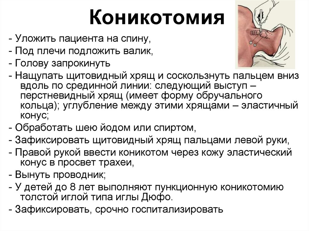 Трахеостома показания. Техника проведения коникотомии алгоритм. Пункционная коникотомия. Алгоритм выполнения коникотомии. Коникотомия техника выполнения алгоритм.