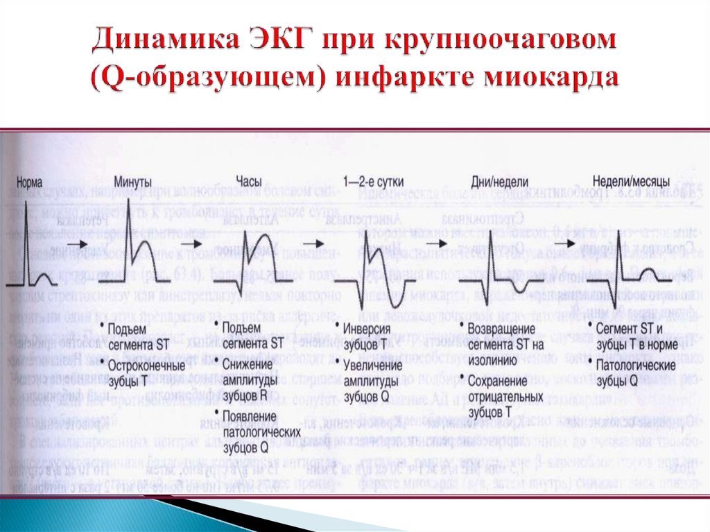 Динамика ЭКГ при крупноочаговом (Q-образующем) инфаркте миокарда