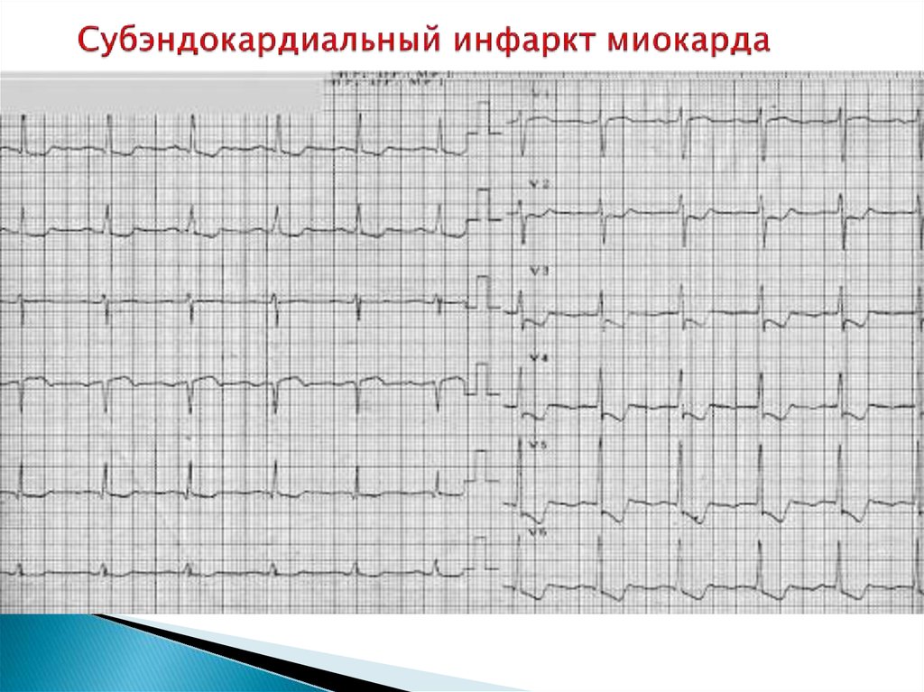 Повреждение миокарда на экг что это