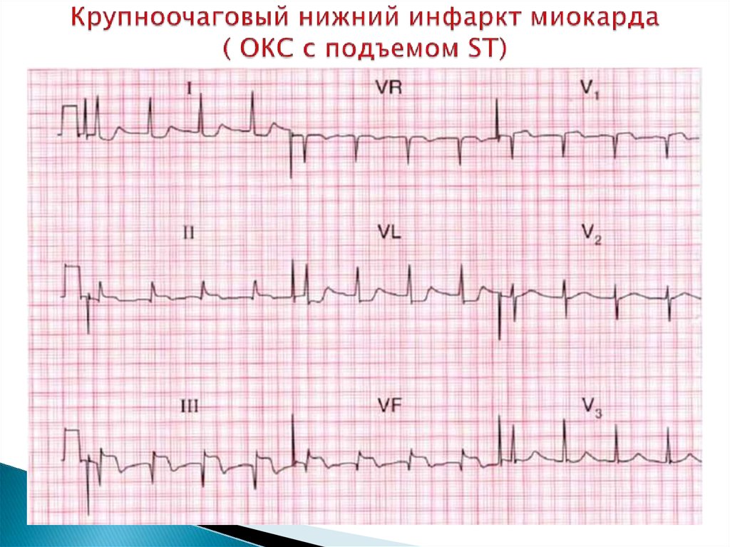 Как выглядит инфаркт на кардиограмме фото