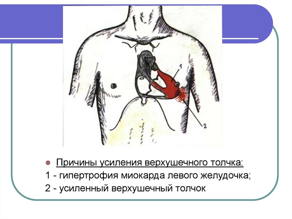 Верхушечный толчок. Усиление верхушечного толчка. Усиленный верхушечный толчок. Верхушечный толчок при гипертрофии левого желудочка. При усилении верхушечного толчпка.