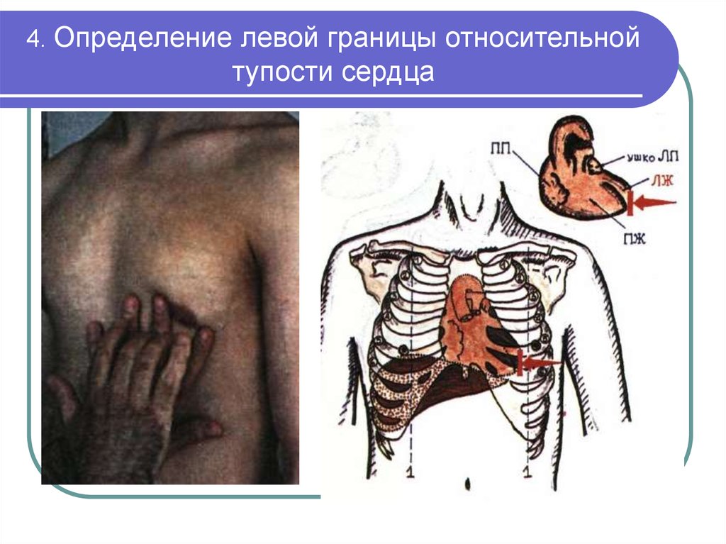 Левое определение. Перкуссия границ относительной сердечной тупости. Относительная тупость сердца пропедевтика. Перкуссия сердца границы относительной сердечной тупости. Определение границ сердца.