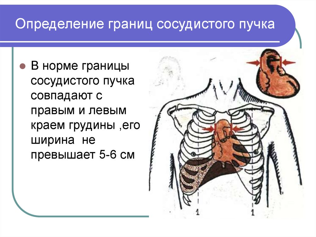 Ширина пучка. Границы сосудистого пучка. Ширина сосудистого пучка. Перкуссия сосудистого пучка. Границы сосудистого пучка в норме.