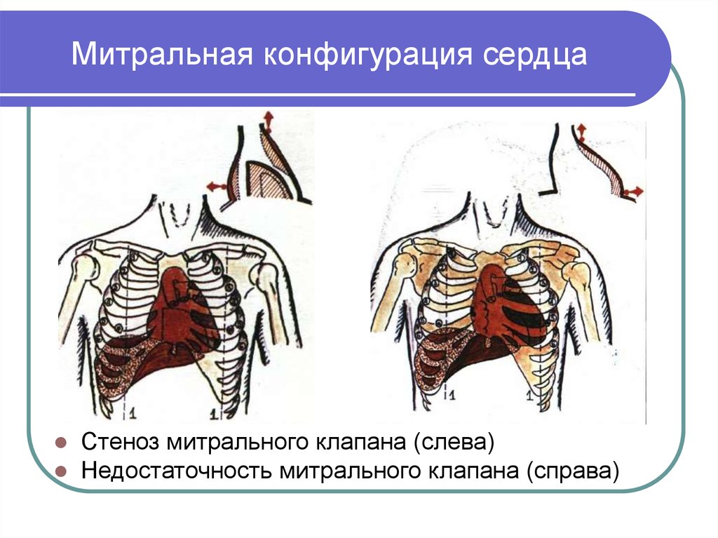 Аортальная конфигурация сердца. Митральная и аортальная конфигурация сердца. Конфигурация сердца при митральной недостаточности. Митральная конфигурация сердца рентген. Конфигурации сердца пропедевтика внутренних болезней.