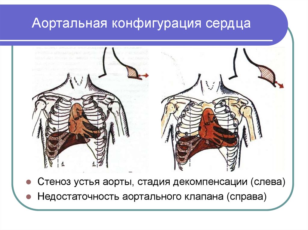 Аортальное сердце. Конфигурация сердца при стенозе аортального клапана. Митральная и аортальная конфигурация сердца. Конфигурация сердца при аортальных пороках. Синдром аортальной конфигурации сердца.