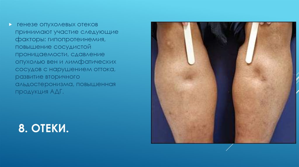 8. Отеки.