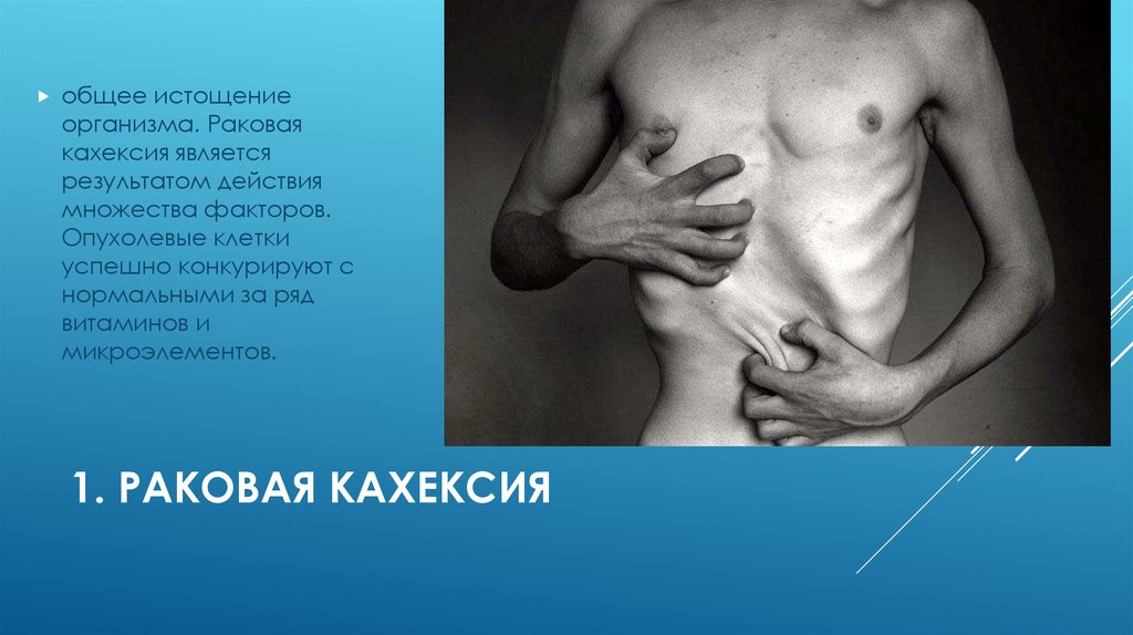 1. Раковая кахексия