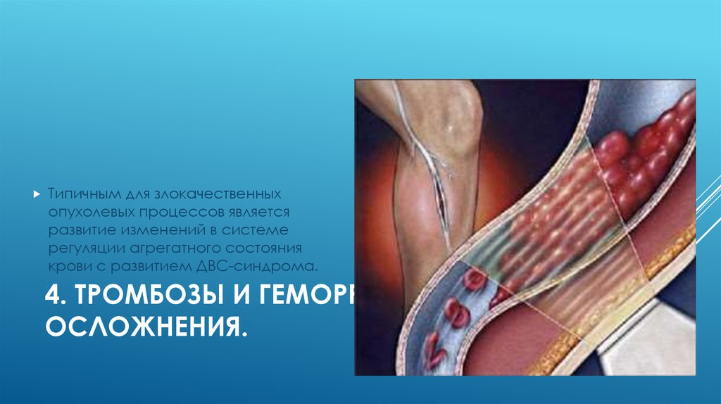 4. Тромбозы и геморрагические осложнения. 