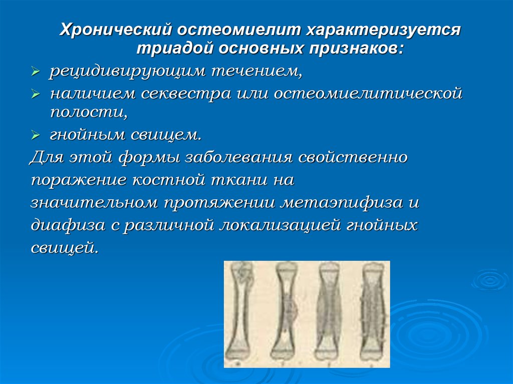 Острый остеомиелит клиническая картина