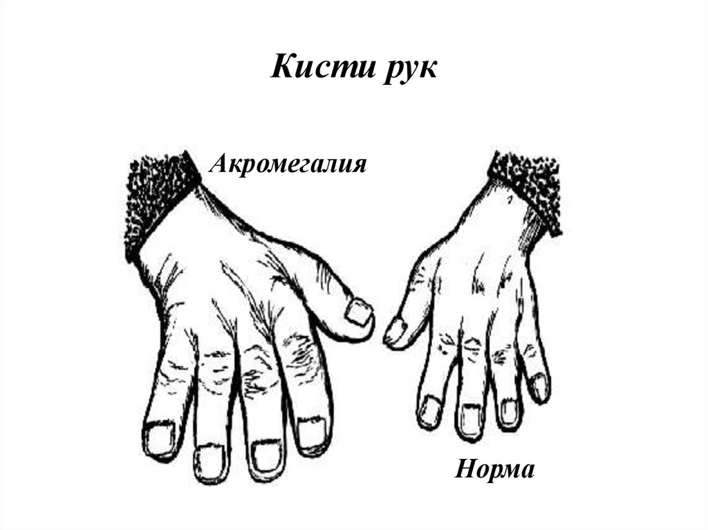 Нормальная руки. Типы кистей рук. Норма кисти рук. Запястье норма. Кисть руки в виде конуса.