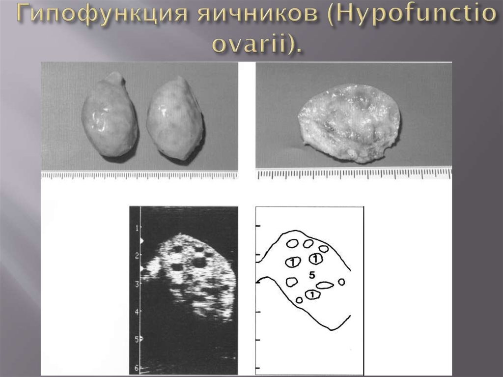 Заболевания яичников. Гипофункция яичников у коров. Первичная гипофункция яичников. Кисты яичников макропрепарат. Гипофункция яичников КРС.