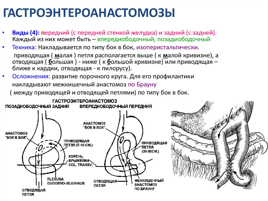 Гастрэктомия по сигалу схема