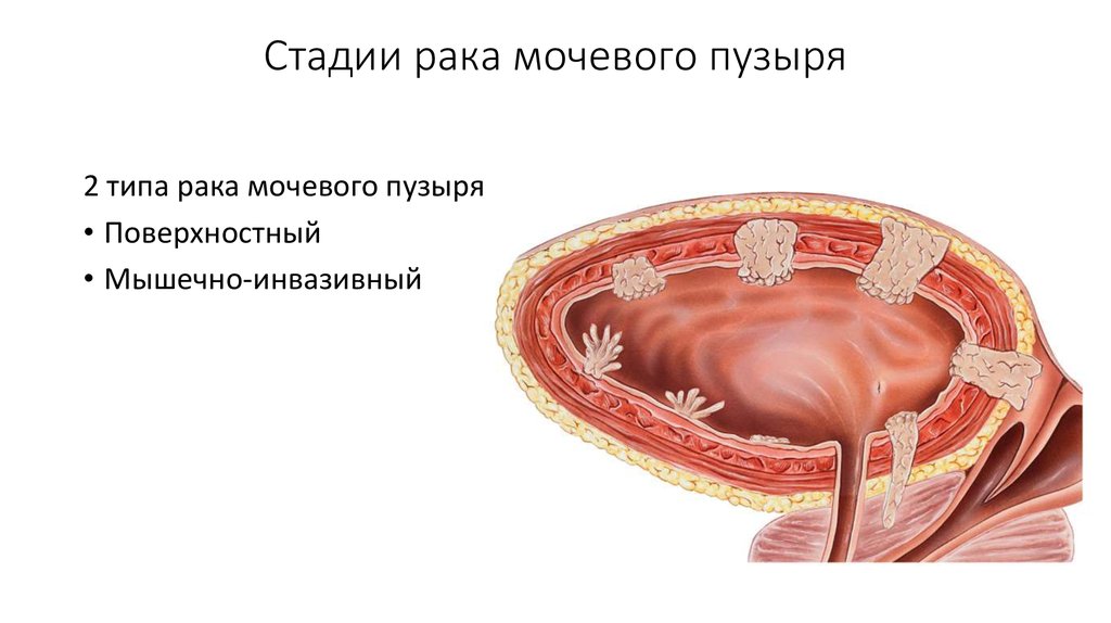Рецидив рак мочевого. Стадии опухоли мочевого пузыря. ЗНО мочевого пузыря стадии. Размер опухоли мочевого пузыря по стадиям. Инвазивная стадия опухоли.
