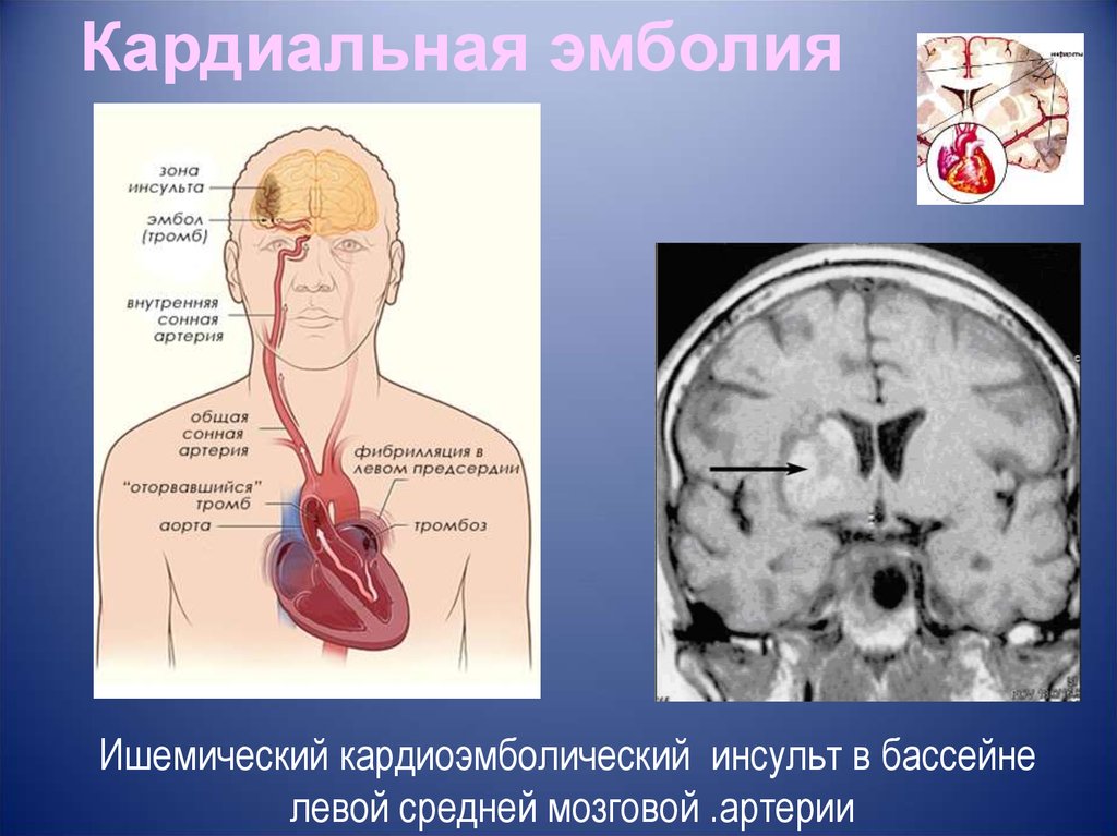 Инсульт левой артерии. Ишемический инсульт головного мозга в бассейне левой СМА. Ишемический инсульт в каротидном бассейне. ОНМК В правой средней мозговой артерии клиника. Ишемический инсульт при поражении средней мозговой артерии.