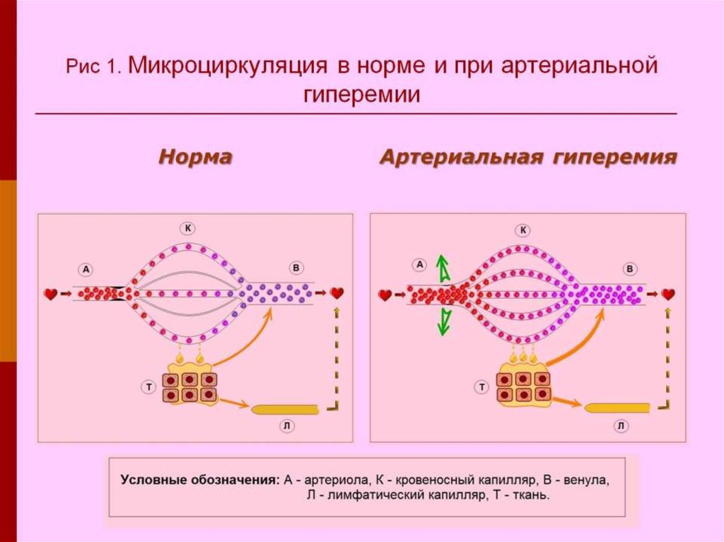 Артериальная гиперемия схема