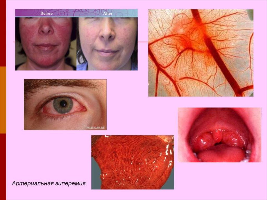 Артериальная гиперемия.