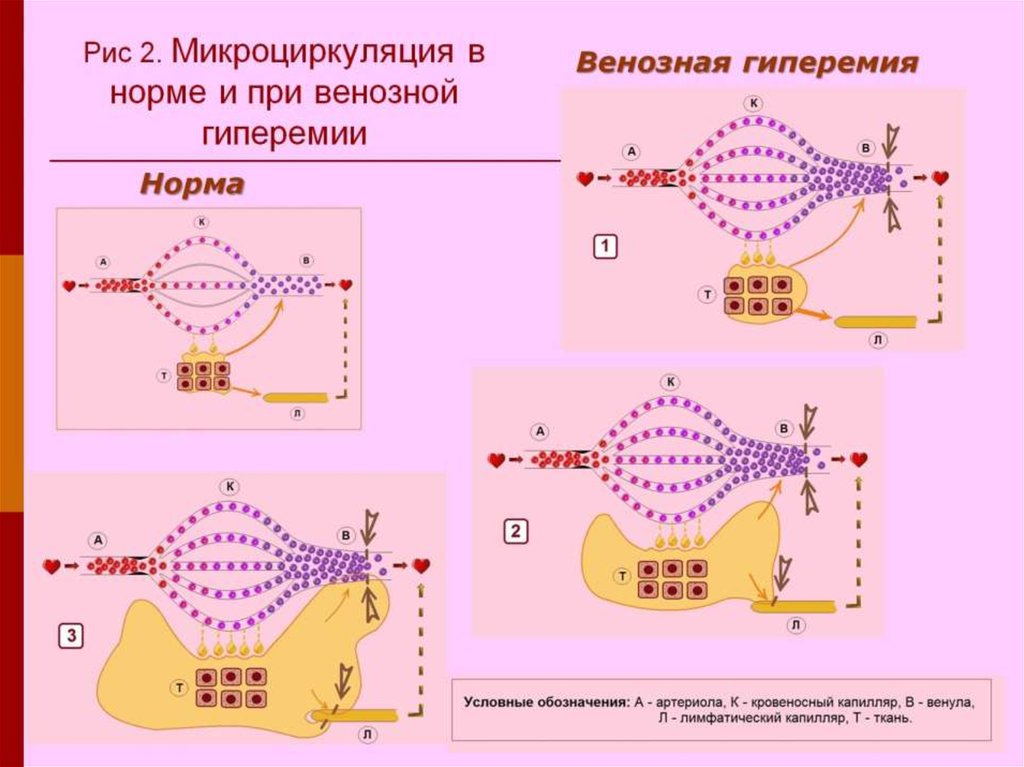 Нарисуйте признаки венозной гиперемии