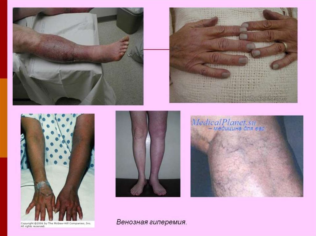Венозная гиперемия.
