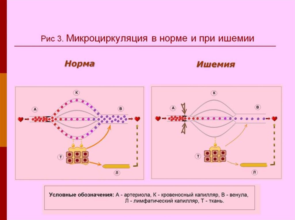 Рис 3. Микроциркуляция в норме и при ишемии