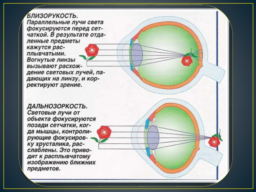 Какой части глазного яблока образуется изображение предмета. Дальнозоркость и близорукость строение глаза. Миопия схема глаза. Строение хрусталика при близорукости. Нарушение зрения близорукость дальнозоркость.