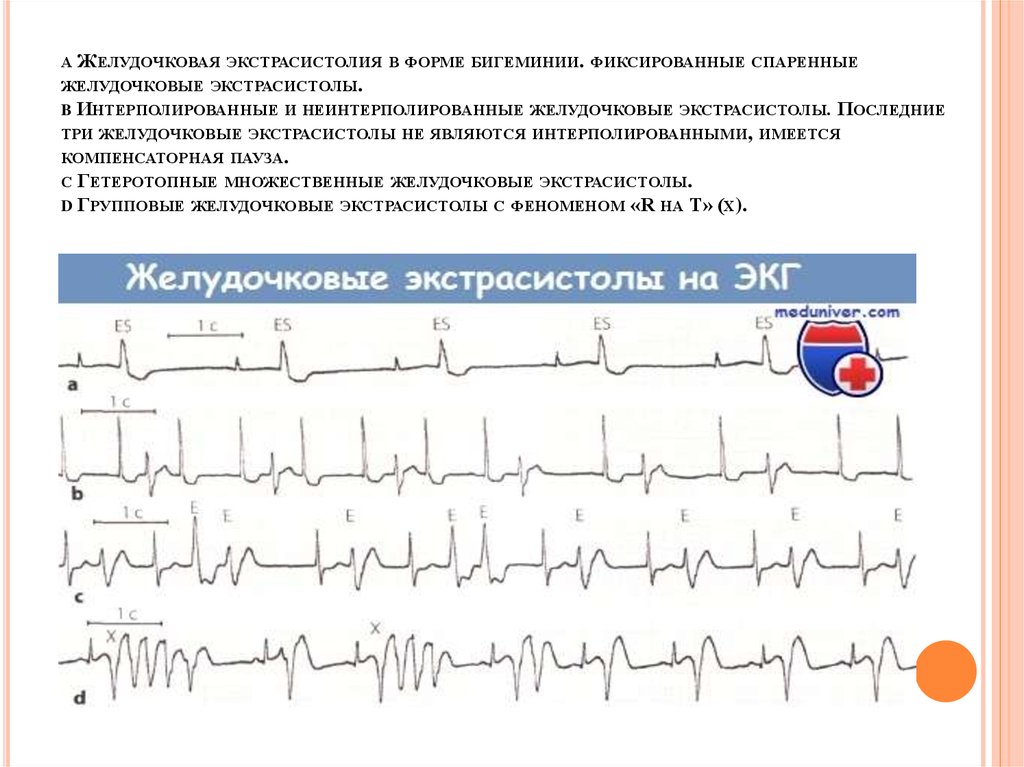 Частые желудочковые экстрасистолы карта вызова