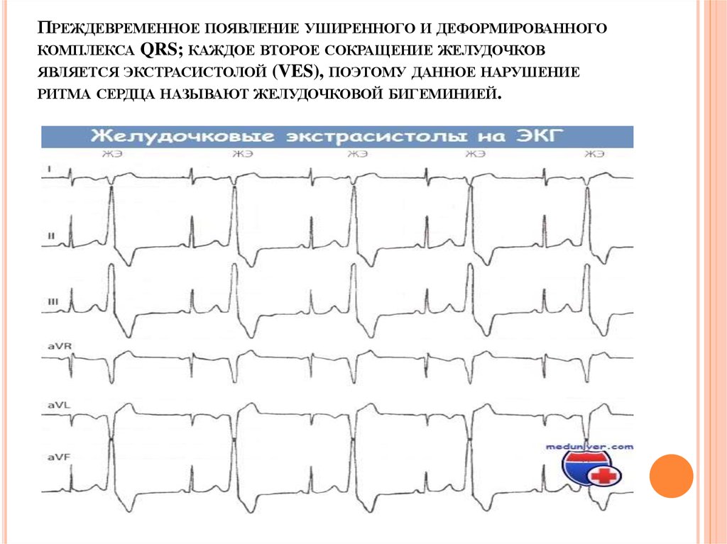 Нарушение ритма по типу бигеминии карта вызова