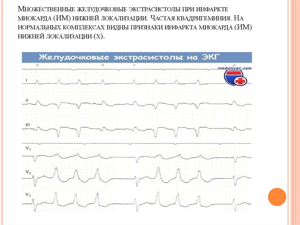 Частые желудочковые экстрасистолы карта вызова