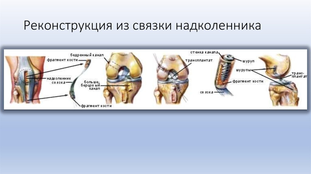 Повреждение связки надколенника. Операция шов связки надколенника. Реконструкция связки надколенника. Собственная связка надколенника.