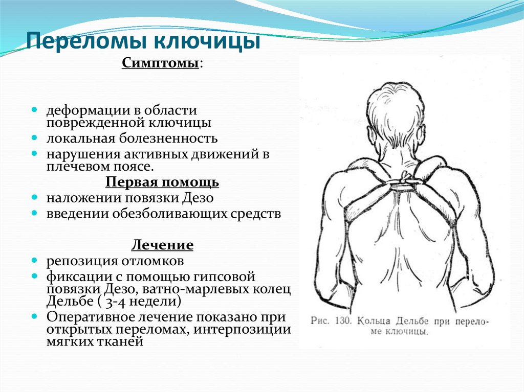 Перелом ключицы как лечить. Перелом ключицы первая помощь алгоритм действий. Закрытый перелом ключицы неотложная помощь. Перелом ключицы первая помощь алгоритм.