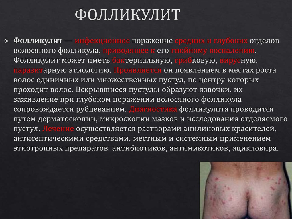 ФОЛЛИКУЛИТ