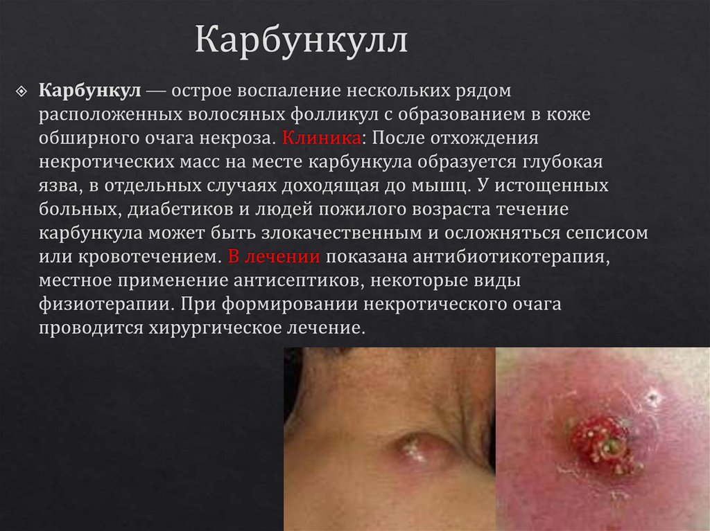 Карбункулл