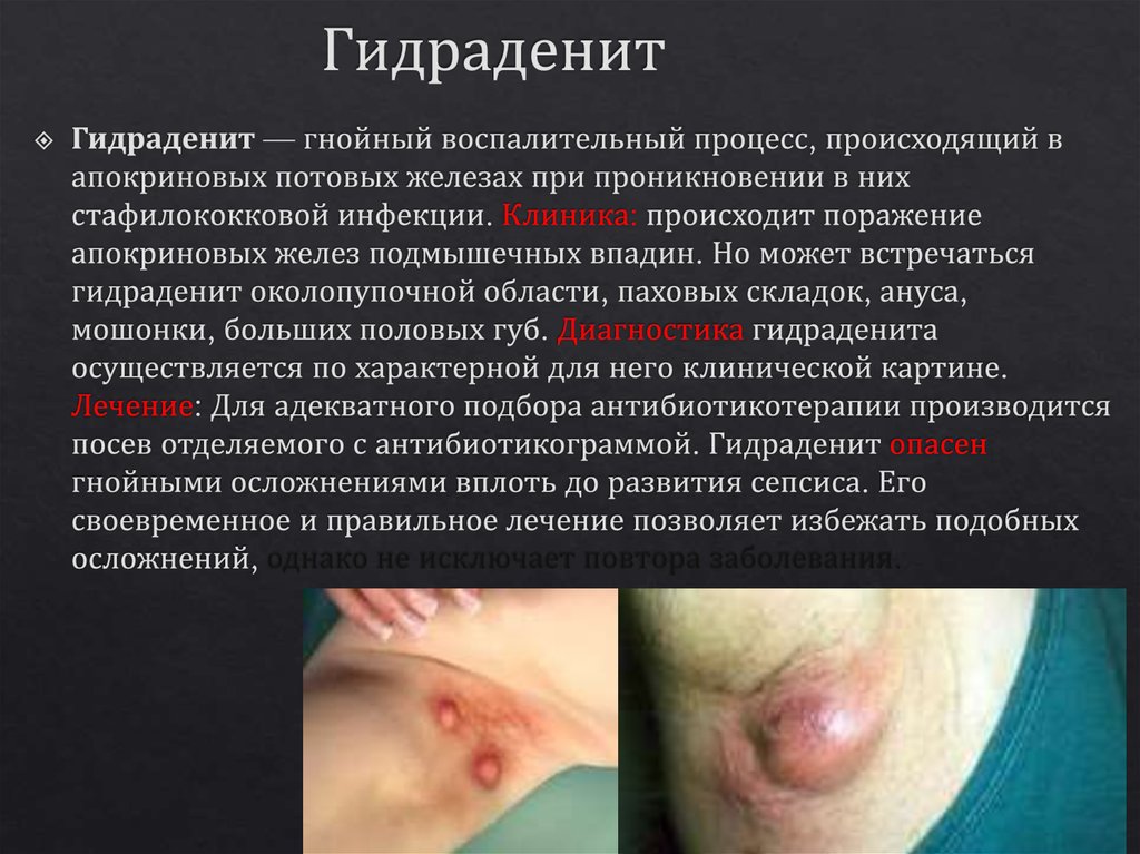 Гидраденит