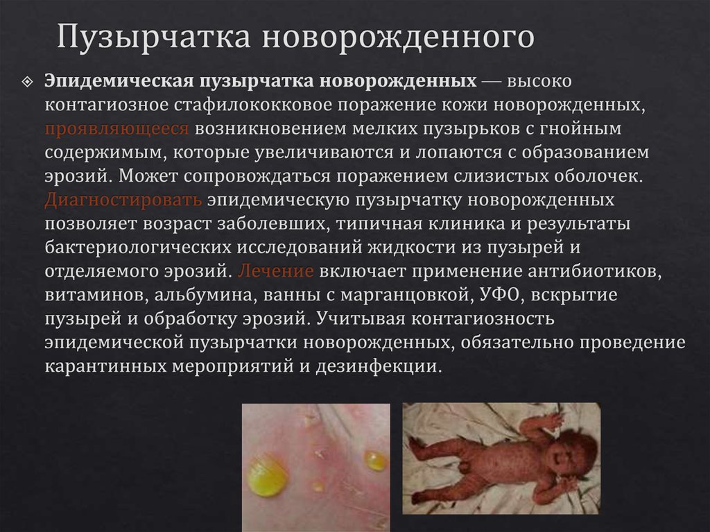 Пузырчатка новорожденного