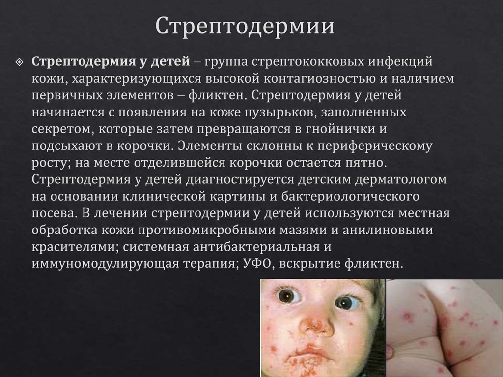 Стрептодермии