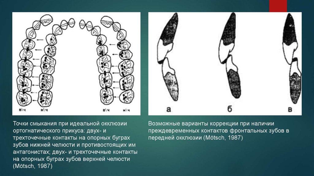 Окклюзионная схема кувата