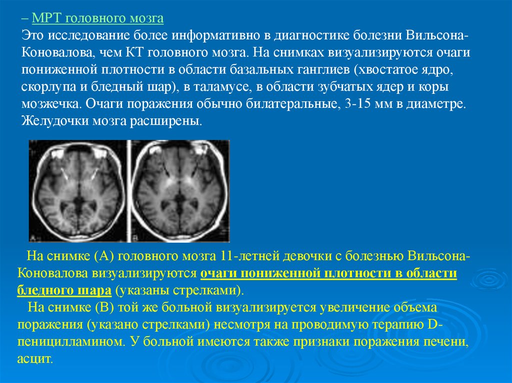 Очаговое поражение. Мрт головного мозга при Вильсона - Коновалова. Кт головного мозга болезнь Вильсона. Мрт головного мозга при болезни Вильсона Коновалова. Болезнь Вильсона Коновалова мрт.