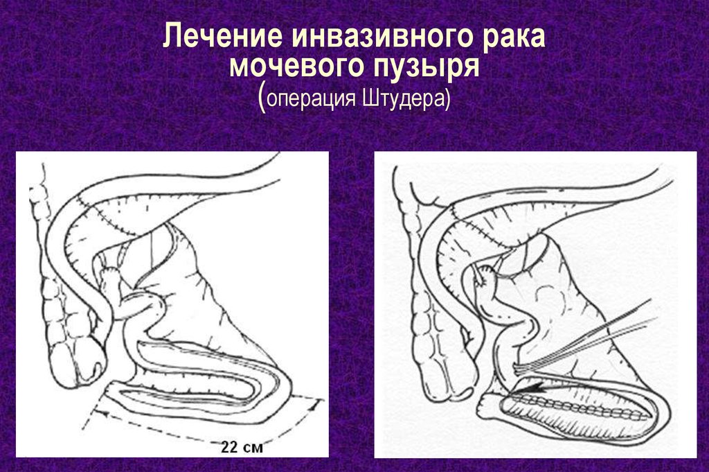 Лечение инвазивного рака мочевого пузыря (операция Штудера)