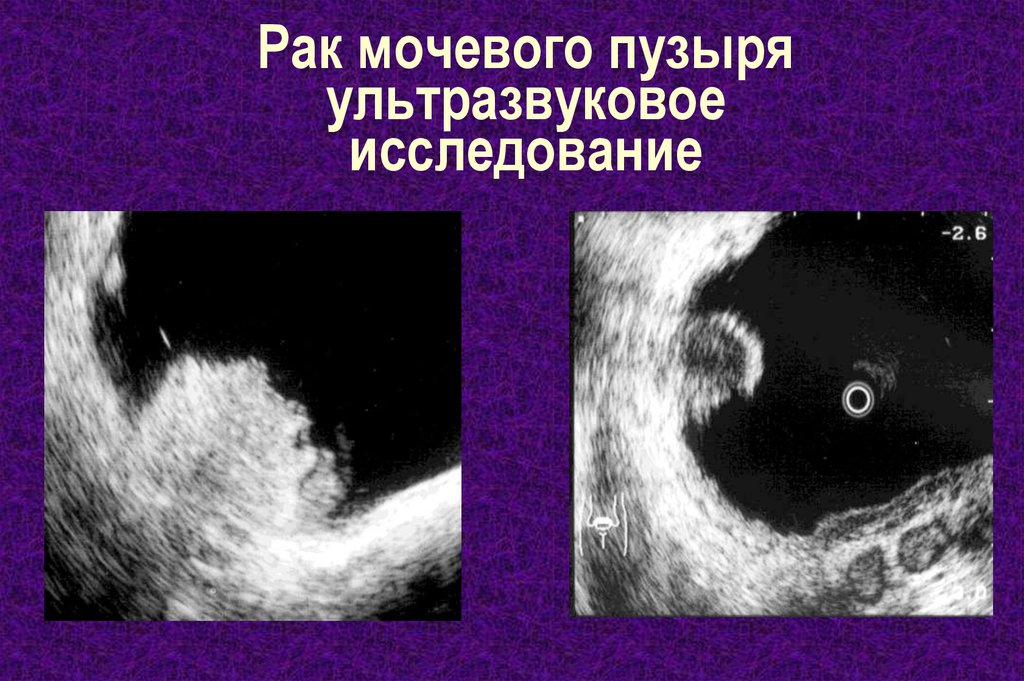 Рак мочевого пузыря у женщин фото