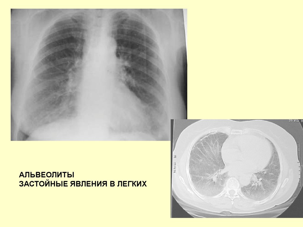 Гипостатические изменения в легких. Рентген застой пневмонии. Гипостатическая пневмония рентгенограмма. Гипостатическая пневмония рентген. Застойные явления в легких.