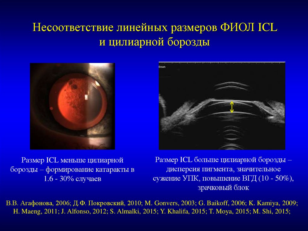 Интраокулярные линзы презентация