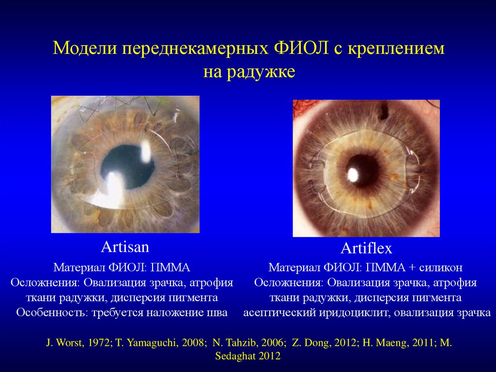 Дисперсия глаза. Синдром пигментной дисперсии глаза. Переднекамерные линзы. Переднекамерные интраокулярные линзы. Дисперсия пигмента глаза.