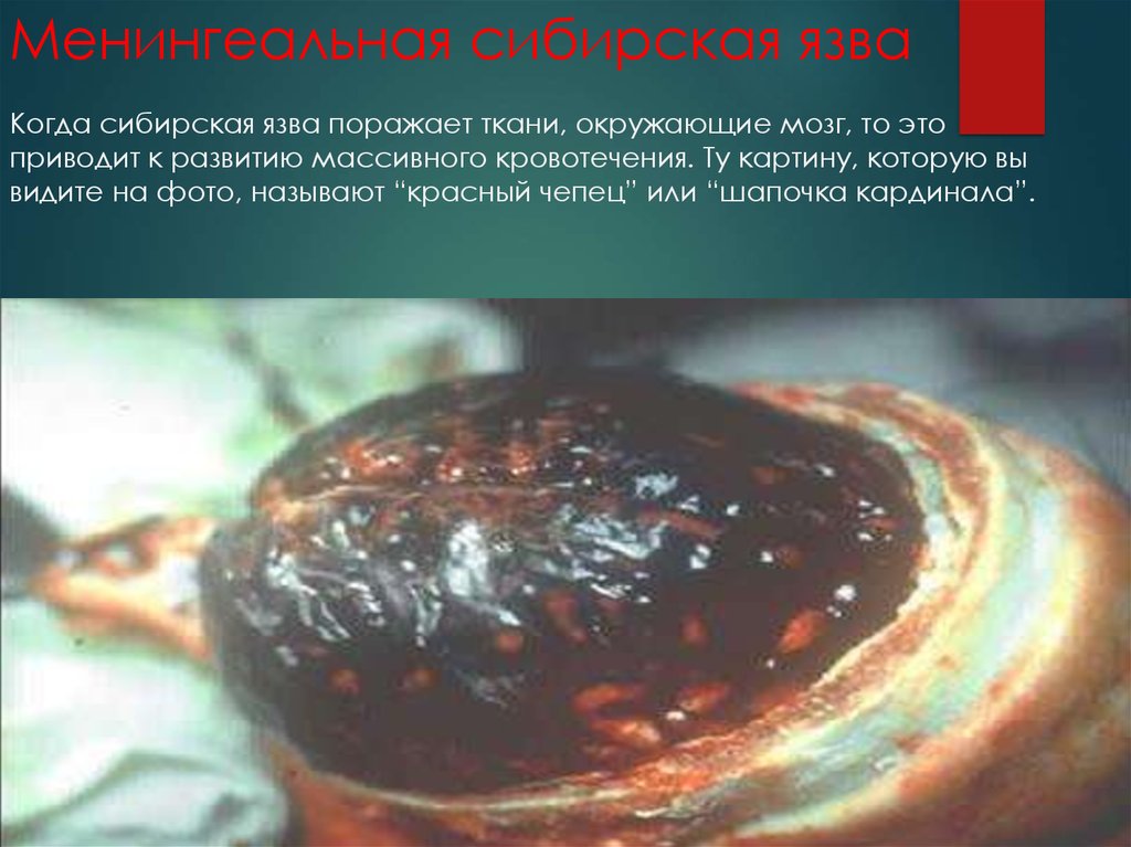 Менингеальная сибирская язва Когда сибирская язва поражает ткани, окружающие мозг, то это приводит к развитию массивного