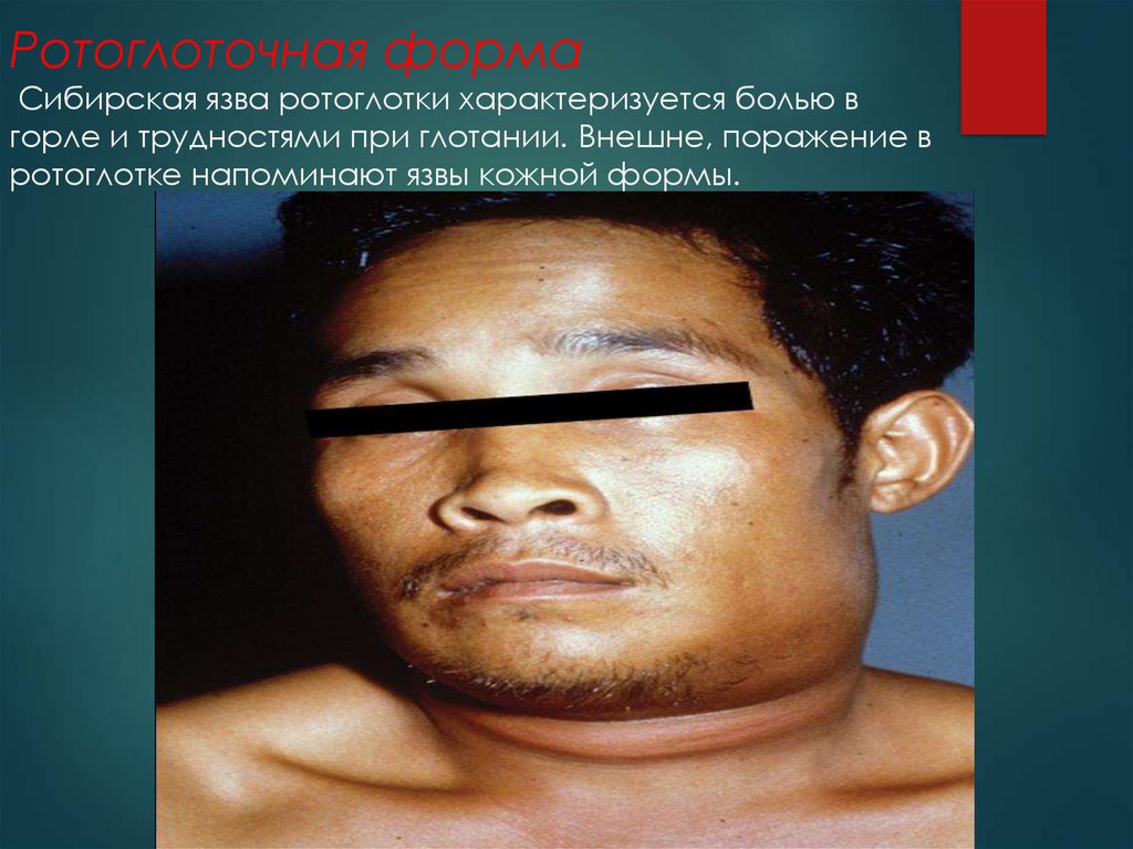 Ротоглоточная форма  Сибирская язва ротоглотки характеризуется болью в горле и трудностями при глотании. Внешне, поражение в